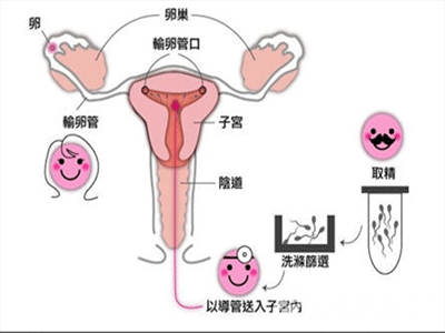 人工受孕成功率多少