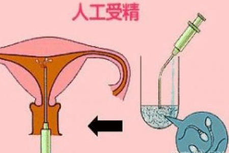 人工受精的费用