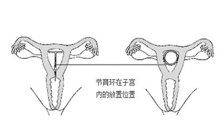 女性上哪种节育环好