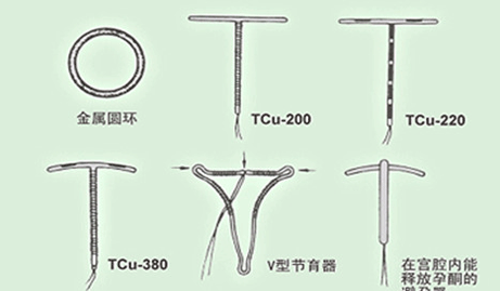 宫内节育器哪种好