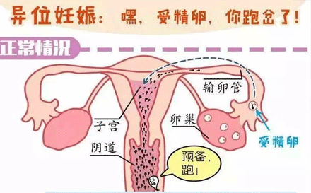 宫外孕后多久能再孕