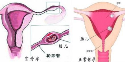 导致宫外孕的原因