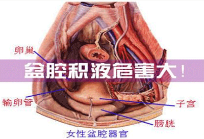 盆腔积液的症状