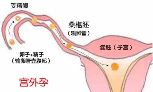 造成宫外孕的原因