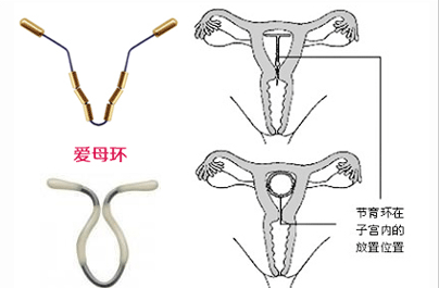 取环术后注意事项