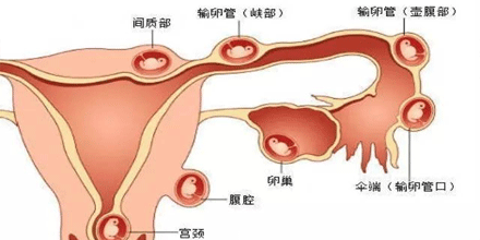 导致宫外孕的原因