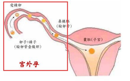 宫外孕后还能怀孕吗