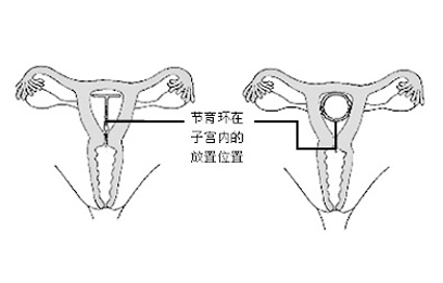 取环手术要多长时间