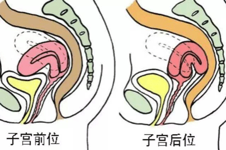 子宫后位如何受孕