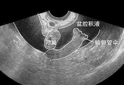 盆腔积液吃什么药好