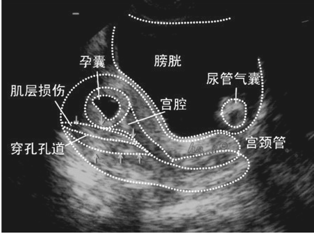 上环的副作用有哪些