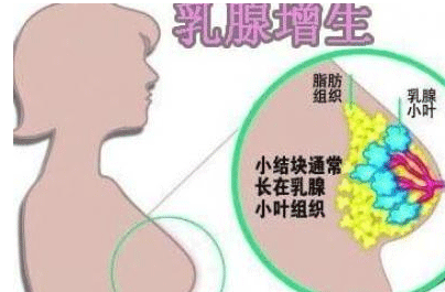 乳腺增生结节是什么意思