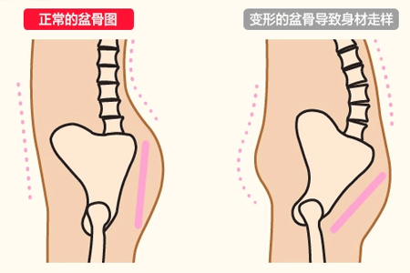 警惕产后骨盆痛护理措施要做好