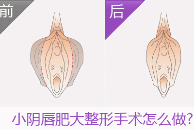 小阴唇整形手术注意事项