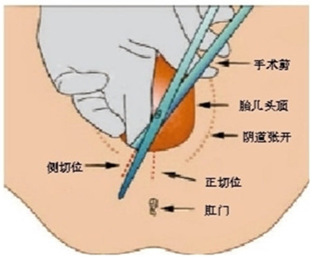 顺产侧切是什么意思