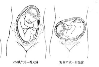 胎儿横位是怎么引起的