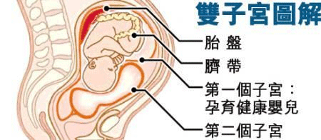 双子宫能顺产吗