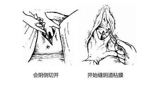 会阴侧切手术护理要点