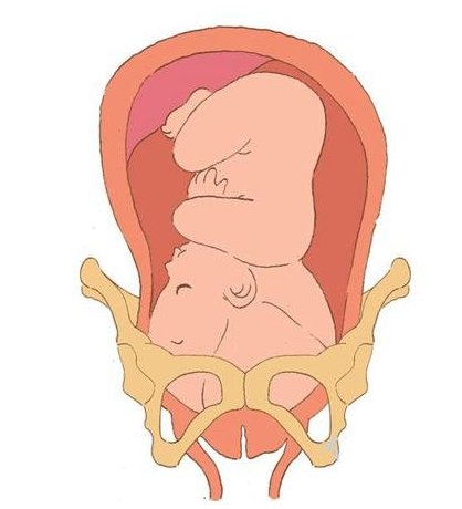 胎儿不入盆的原因