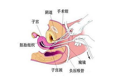 做人流痛不痛