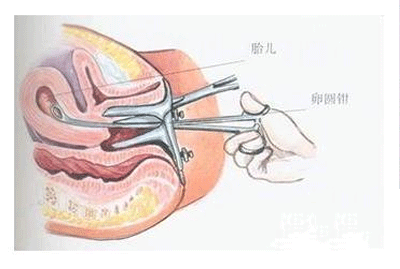 做人流痛不痛