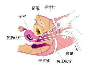 怀孕多久不能做人流