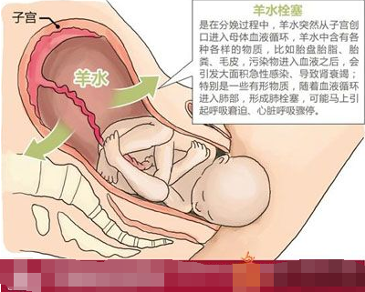 羊水栓塞的原因和症状