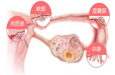 输卵管堵塞怎么治