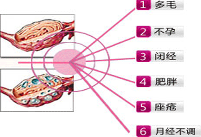 多囊性卵巢综合症的症状