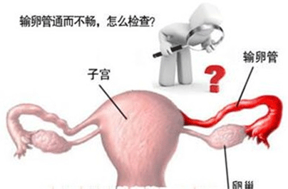 输卵管堵塞怎么治