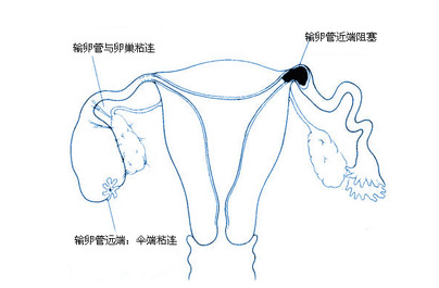 输卵管造影是什么