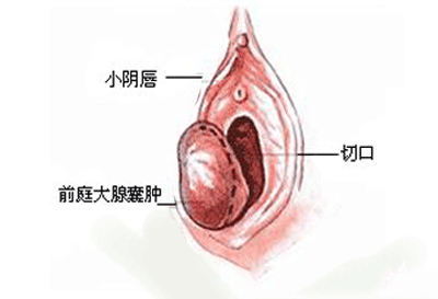 前庭大腺囊肿原因