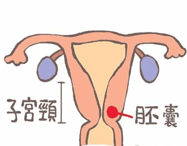 宫颈妊娠的原因