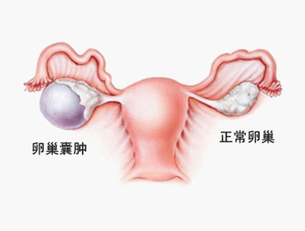 卵巢囊肿影响生育吗