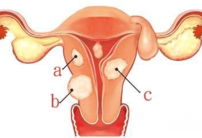 子宫息肉是如何产生的需要手术治疗吗