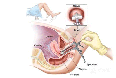 妇科tct检查费用及项目须知