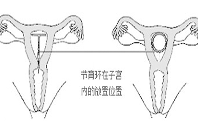 上环的副作用