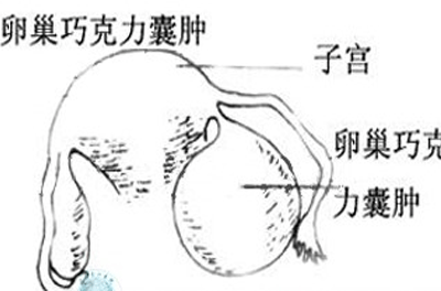 巧克力囊肿严重吗