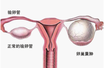 卵巢囊肿治疗方法有哪几种