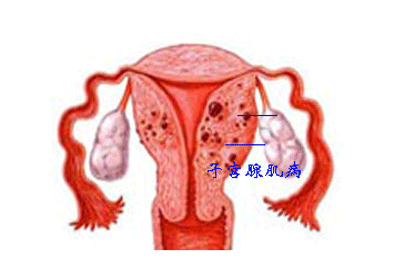 子宫腺肌症的治疗