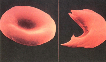 镰刀型细胞贫血症的症状