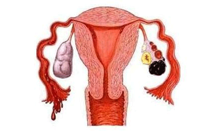 卵巢囊肿多大需手术卵巢囊肿的治疗