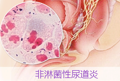 了解非淋性尿道炎病因做好预防措施