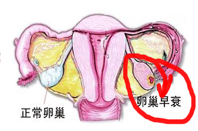 卵巢功能早衰症状