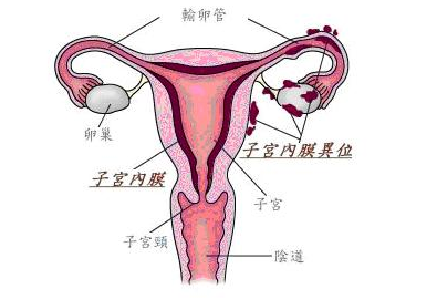 子宫内膜异位有什么症状