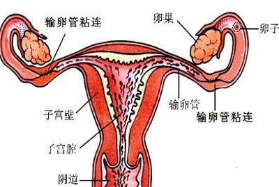 输卵管粘连什么症状