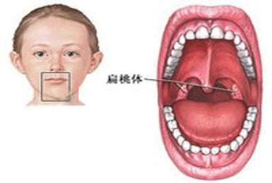 儿童扁桃体炎的病因