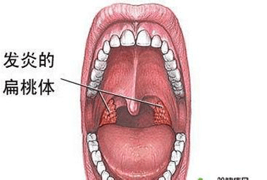 儿童扁桃体炎的治疗