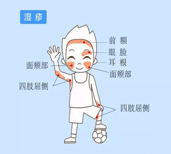 宝宝起湿疹的护理措施