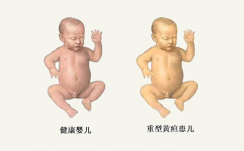 母乳性黄疸的症状